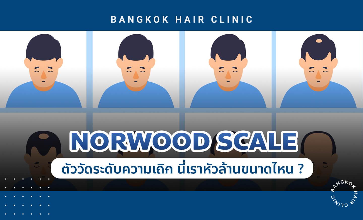 นี่เรา ‘หัวล้าน’ ขนาดไหน?  มารู้จักกับ Norwood Scale (ตัววัดความเถิก)