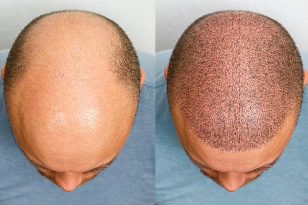 For permanent results, visit a hair loss clinic in Bangkok