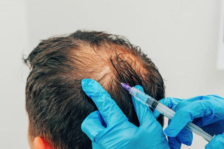 Comparing Prp Vs Stem Cell Treatments For Hair Loss