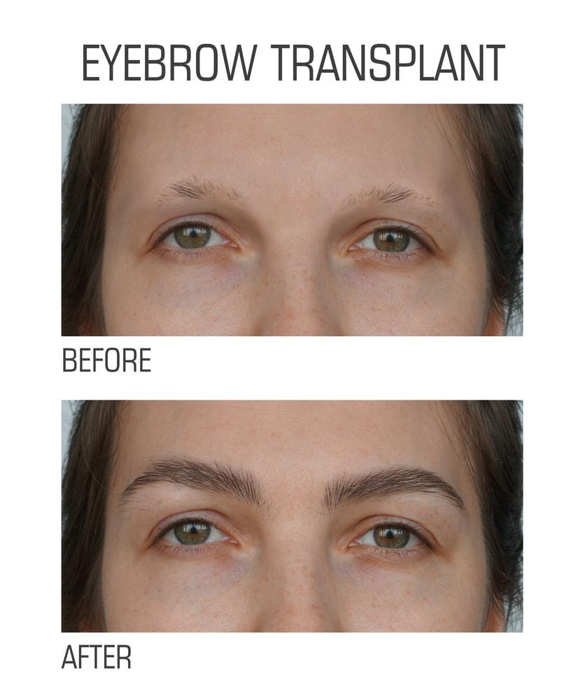 Benefit from Fuller Brows with Eyebrow Transplants