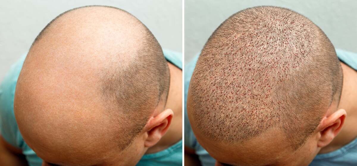 Tips on Choosing a Hair Transplant Clinic