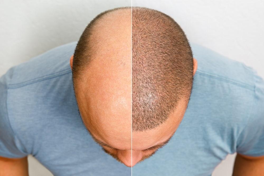 Hair transplants are a permanent solution to hair loss