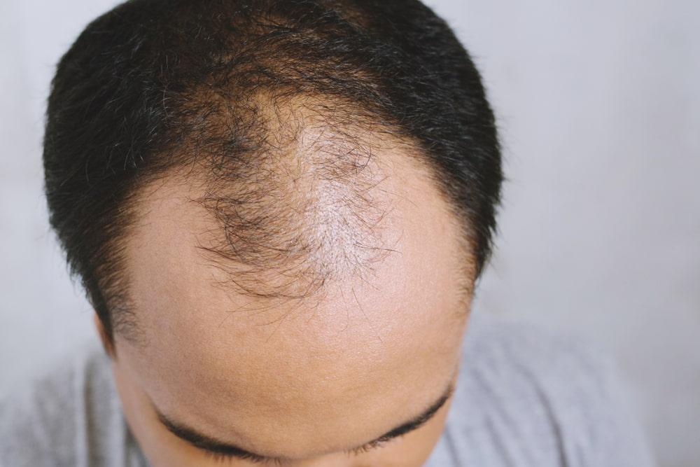 A man exhibiting hereditary hair loss