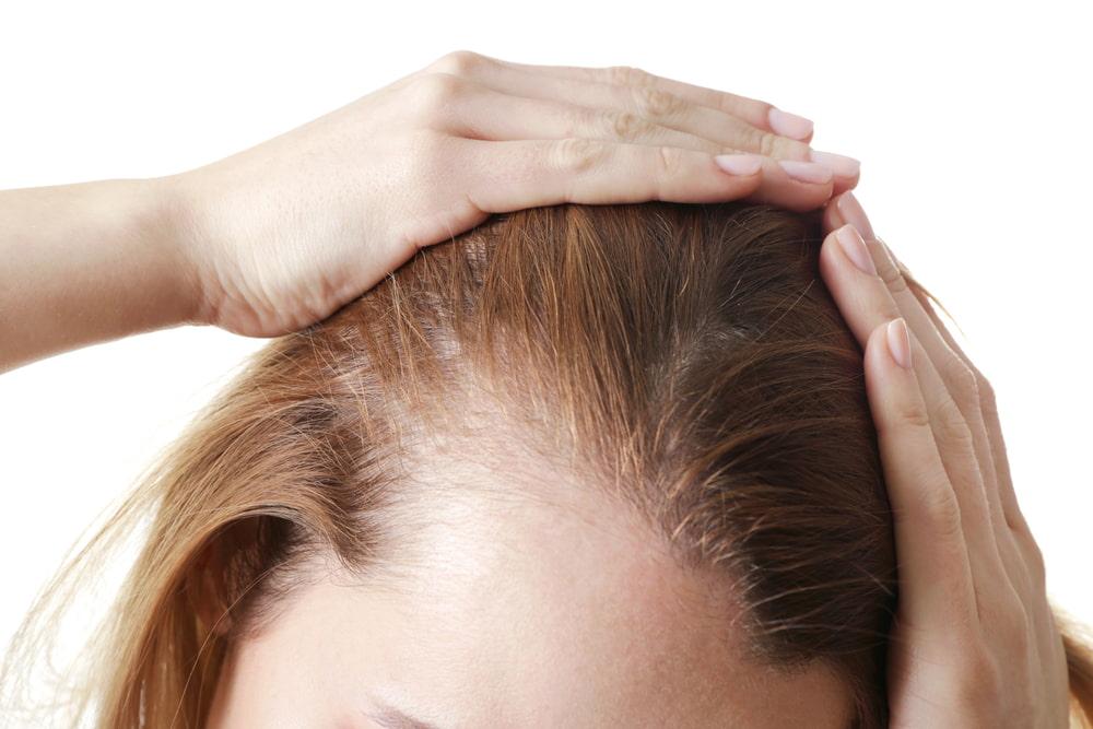 Understanding and Managing Female Pattern Hair Loss