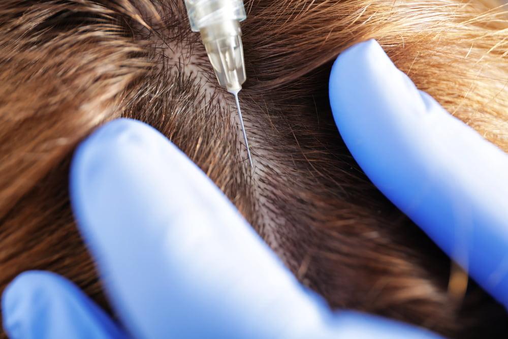 A woman getting PRP injection treatment for hair loss