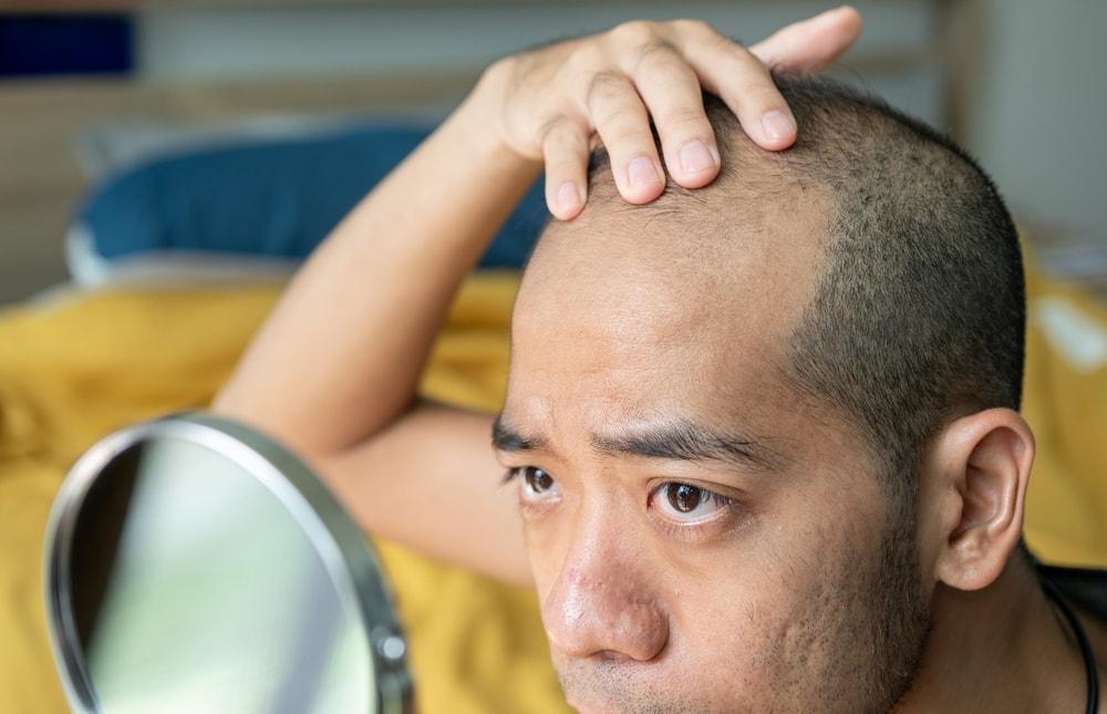 A considers solutions to his hair loss problems