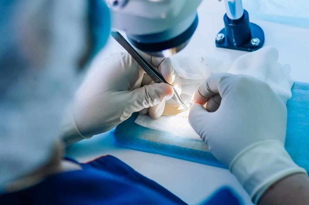 A doctor examining hair for a transplant