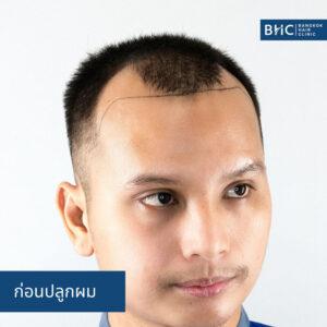 ปลูกผม Non-Shaven 3300 กราฟต์ ก่อนปลูกผม