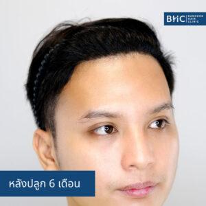 ปลูกผม Non-Shaven 3300 กราฟต์ หลังปลูก 6 เดือน