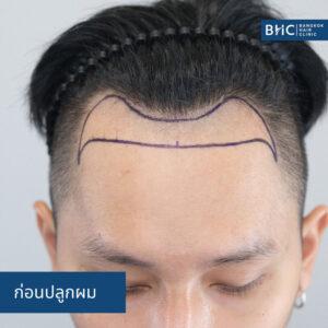 ปลูกผม Fue Shaven 2ุ600 กราฟต์ ก่อนปลูกผม