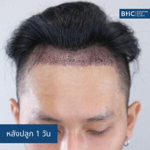 ปลูกผม Fue Shaven 2ุ600 กราฟต์ หลังปลูก 1 วัน