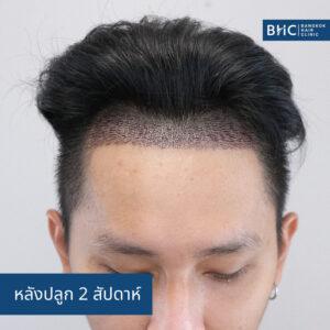 ปลูกผม Fue Shaven 2ุ600 กราฟต์ หลังปลูก 2 สัปดาห์