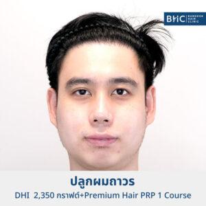 FUE พร้อมเครื่องปลูกผม (DHI) 2350 กราฟต์