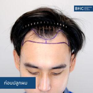 FUE พร้อมเครื่องปลูกผม (DHI) 2350 กราฟต์ ก่อนการปลูกผม