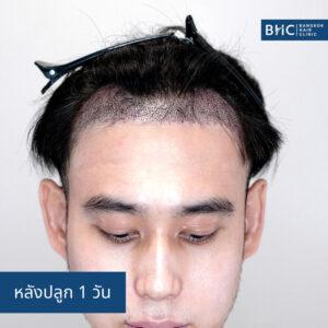 FUE พร้อมเครื่องปลูกผม (DHI) การปลูกผม 2,350 กราฟต์ หลังปลูก 1 วัน