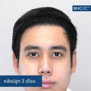 FUE พร้อมเครื่องปลูกผม (DHI) การปลูกผม 2,350 กราฟต์ หลังการปลูก 3 เดือน