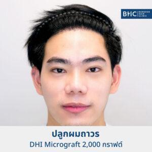 FUE ปลูกผมด้วยเครื่องปลูกผม (DHI) 2,000 กราฟต์