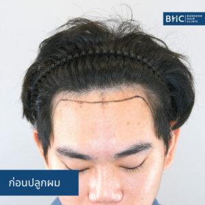 FUE with Implanter (DHI) Hair Transplanter 2000 กราฟต์ ก่อนการปลูกผม