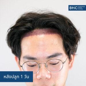 FUE with Implanter (DHI) ปลูกผม 2,000 กราฟต์ หลังปลูก 1 วัน