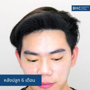 FUE พร้อมเครื่องปลูกผม (DHI) การปลูกผม 2,000 กราฟต์ หลังการปลูก 6 เดือน