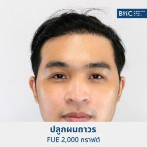 ปลูกผม Fue Shaven 2000 กราฟต์