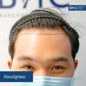 ปลูกผม Fue Shaven 2000 กราฟต์ ก่อนปลูกผม