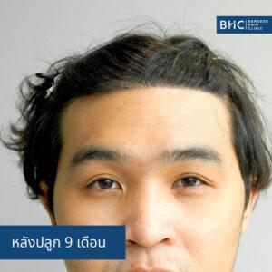 ปลูกผม Fue Shaven 2000 กราฟต์ หลังปลูก 9 เดือน