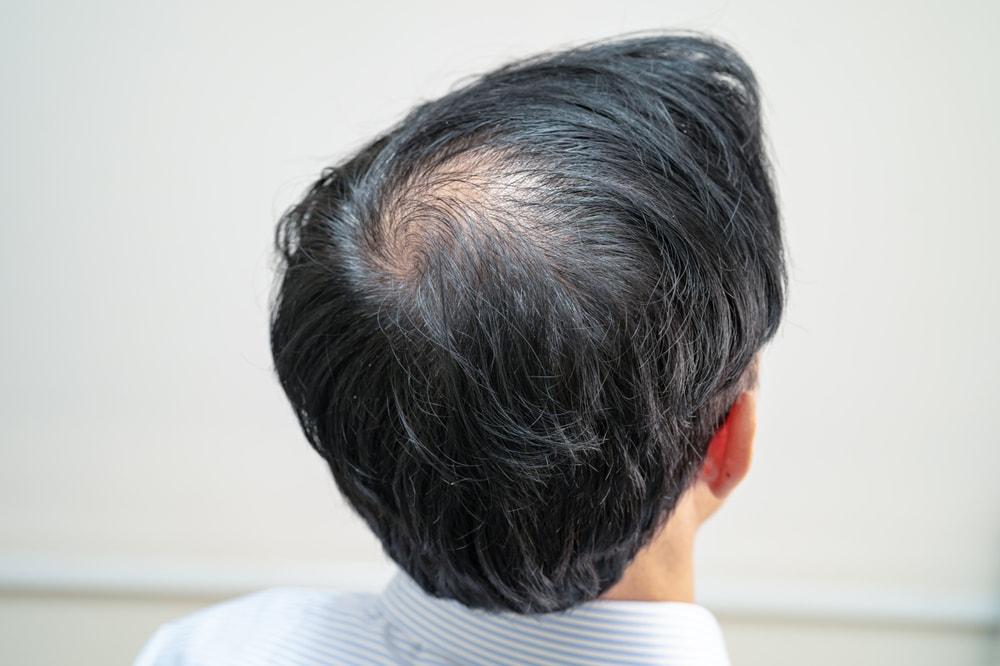 Pattern baldness affects 95% of all men