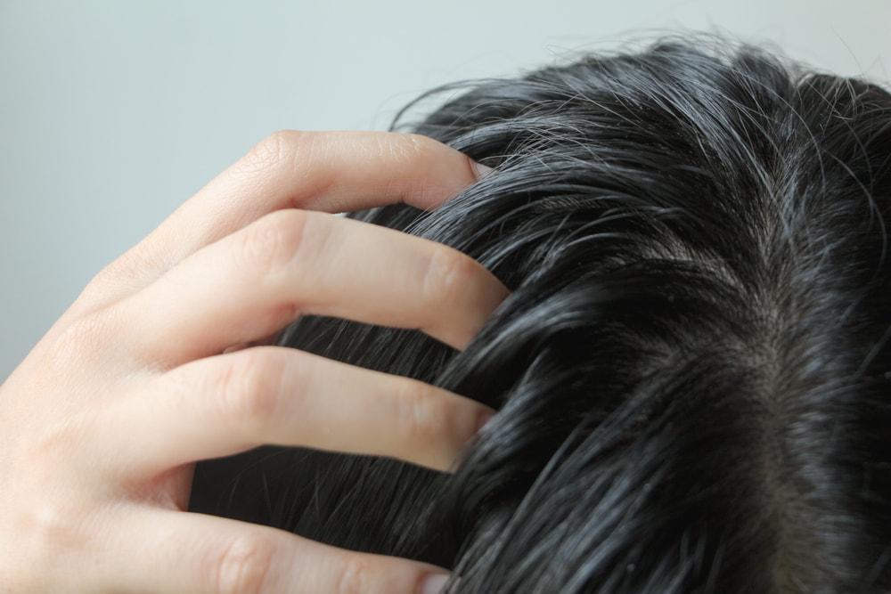 Understanding Oily Hair and Scalp: Does It Cause Hair Loss?