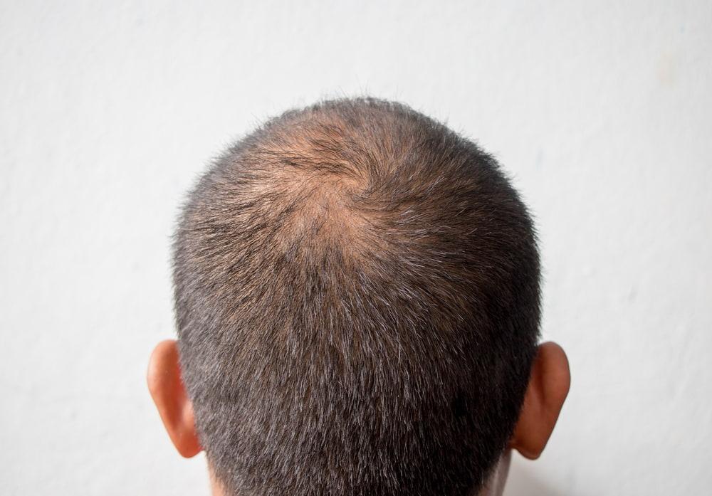 ผู้ชายที่ประสบปัญหาผมบางและจำเป็นต้องใช้ยา Finasteride